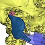 Indywidualny implant wydrukowany w drukarce 3D