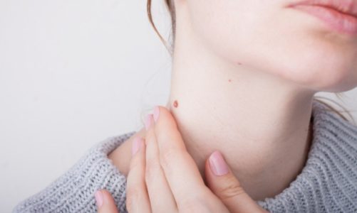 Szybka diagnoza, proste badanie ? jak skutecznie walczyć z czerniakiem?